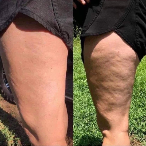 Smooth The Cellulite - Picture 3 of 7